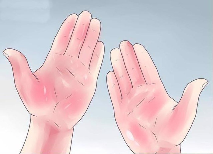 Dấu hiệu lòng bàn tay liên quan đến bệnh gan