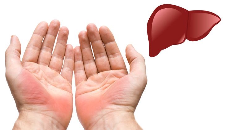 Những biểu hiện của lòng bàn tay với các triệu chứng gan