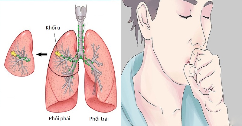 Khối u trong phổi và cách phòng ngừa